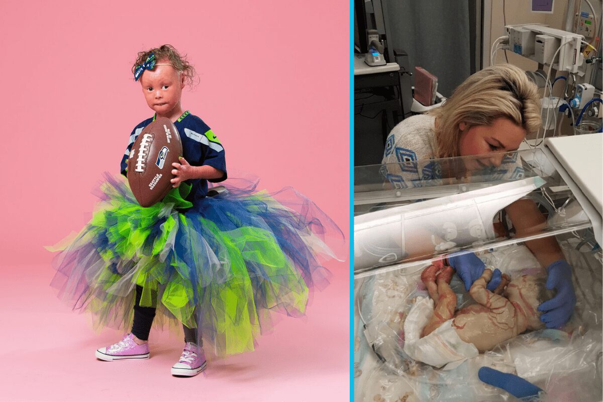 4-year-old born with rare skin condition becomes model so she can redefine beauty for other kids with differences.